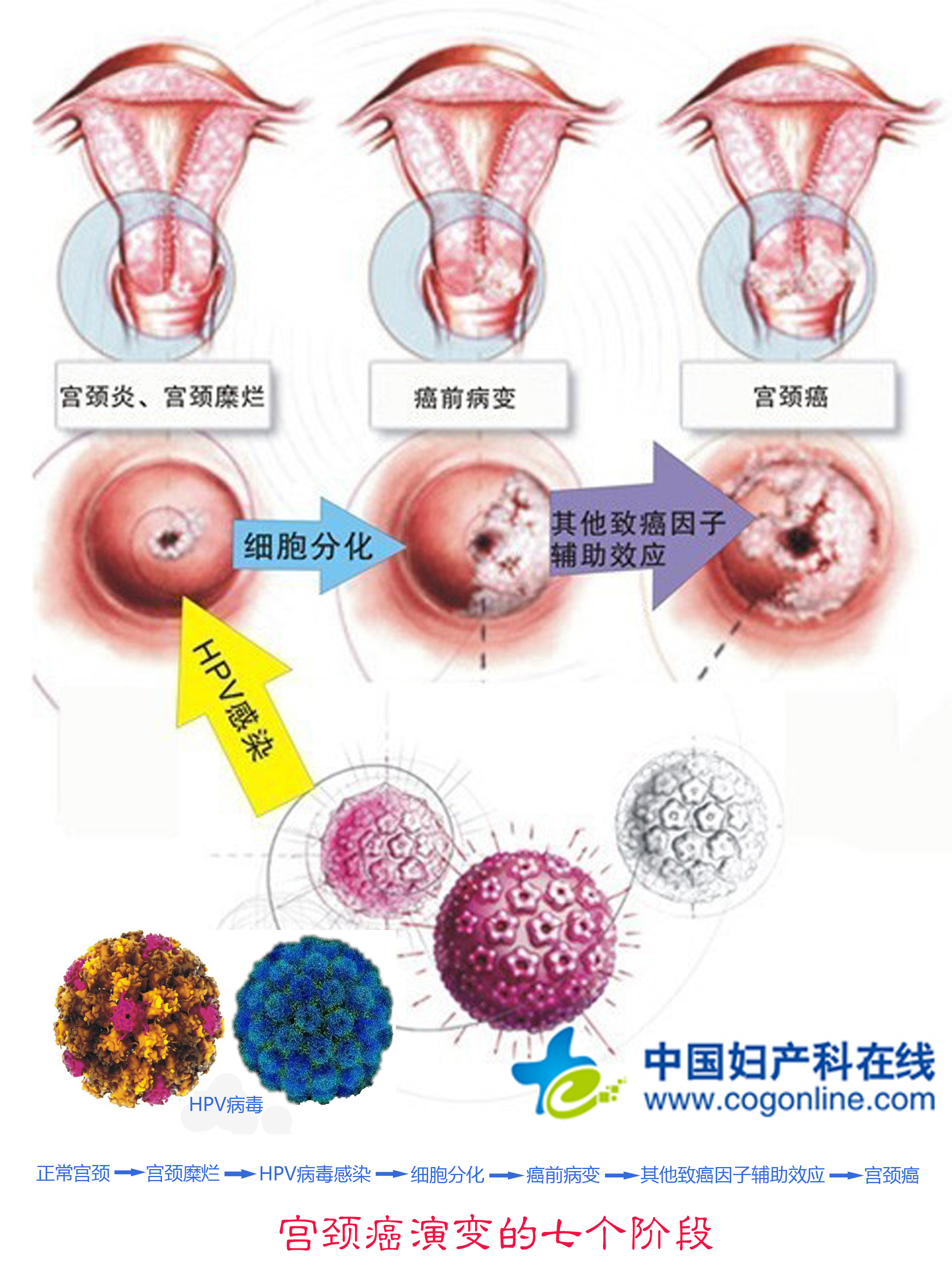 宫颈癌演变的七个阶段 家家健康信息网